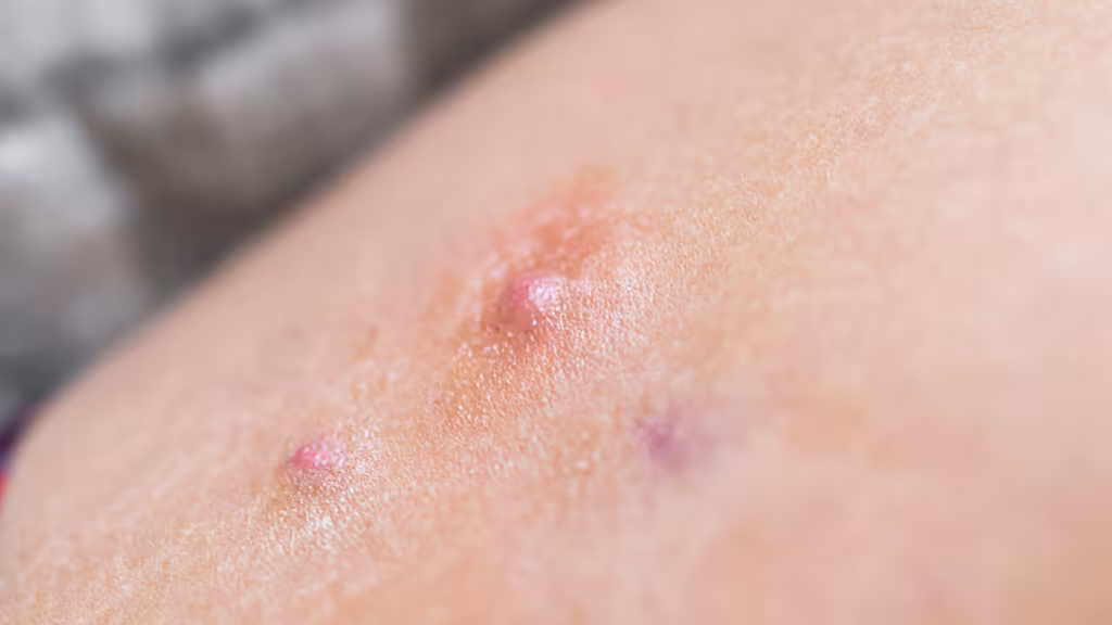 AbbVie skin disorder drug succeeds in late-stage trial, but misses market expectations