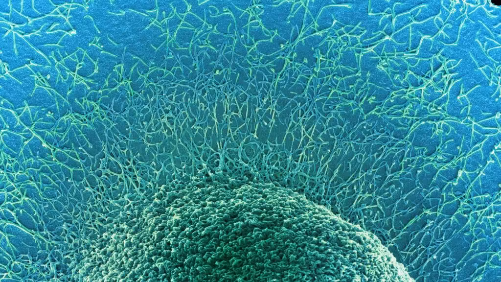 Researcher Q&A: Why is colorectal cancer more dangerous in the young?