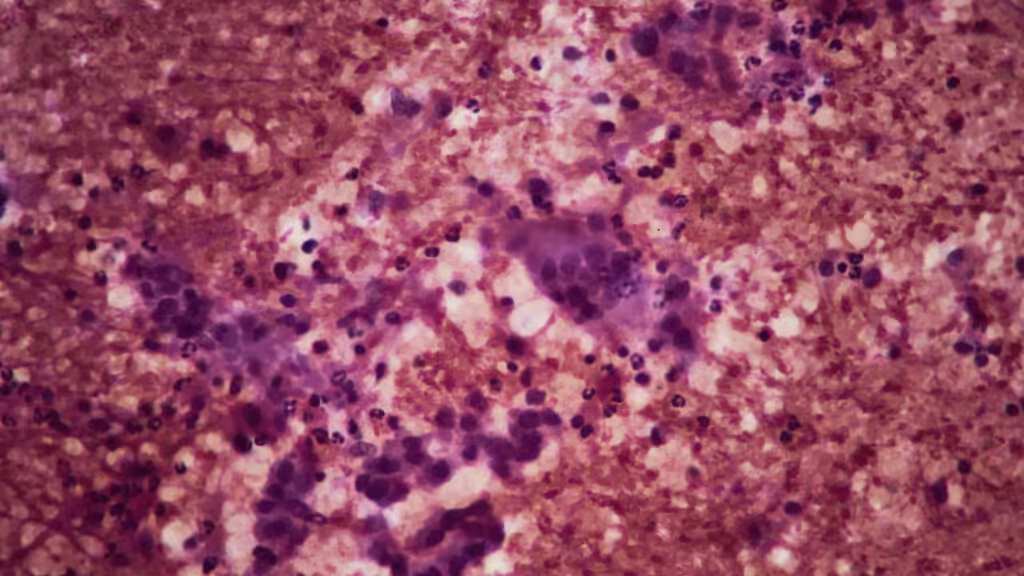 Tango Therapeutics reports pancreatic cancer results| STAT